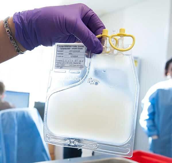 Person wearing a purple glove holds a transparent bag filled with a milky white liquid, the manufactured CAR T cells. The bag has yellow caps and a label with information.