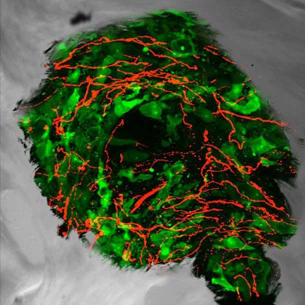 Fluorescent microscope image showing sensory nerve fibers in red infiltrating and growing into green prostate cancer cells that have metastasized to bone tissue.