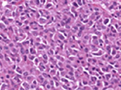 Microscopic image showing SDHC epimutant GIST (gastrointestinal stromal tumor) with epithelioid morphology, displaying pink-purple stained cells with characteristic round to oval nuclei.