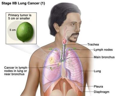 Illustration of a male figure showing the anatomy of the lungs with stage 2B lung cancer