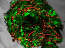 Fluorescent microscope image showing sensory nerve fibers in red infiltrating and growing into green prostate cancer cells that have metastasized to bone tissue.