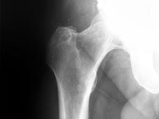 X-ray image showing the hip and upper thigh bone area, revealing a metastatic tumor that has spread to the bone tissue.