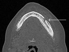 A CT scan of a jaw with an arrow pointing to an open area in the bone.